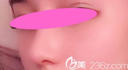 找景德镇艺美虞国锋做假体+半肋骨隆鼻术后第10天效果