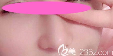 花9800元找景德镇艺美虞国锋做假体+半肋骨隆鼻术后第36天恢复效果