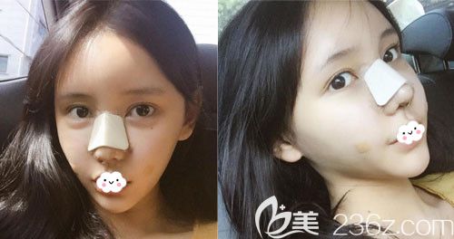 韩国DI医院假体隆鼻+鼻尖鼻中隔修复术后3天恢复图