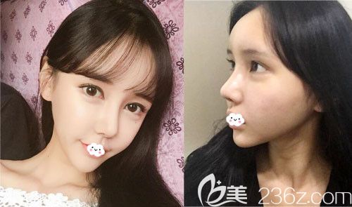 韩国DI医院假体隆鼻失败修复+脂肪面部填充恢复图