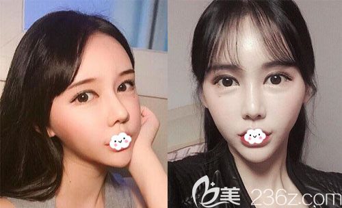 韩国DI整形医院鼻修复+自体脂肪面部填充术后1个月效果图