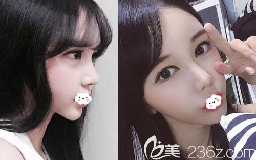 鼻整形失败到韩国DI整形医院做假体隆鼻+鼻尖鼻中隔软骨修复及全脸脂肪填充案例恢复图