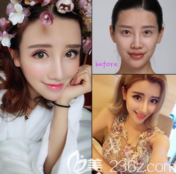 烟台鹏爱医院隆鼻的照片