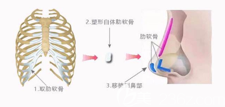 自体肋软骨隆鼻示意图