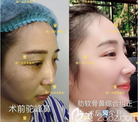 兰州韩美整形自体肋软骨鼻综合隆鼻案例