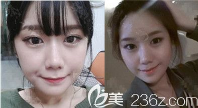 必妩整形医院尹昶云轮廓真人案例 必妩整形医院尹昶云轮廓真人案例