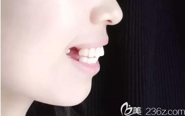 矫正前拔牙后照片