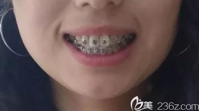 刘炳黎院长牙齿矫正案例中初戴牙套的照片