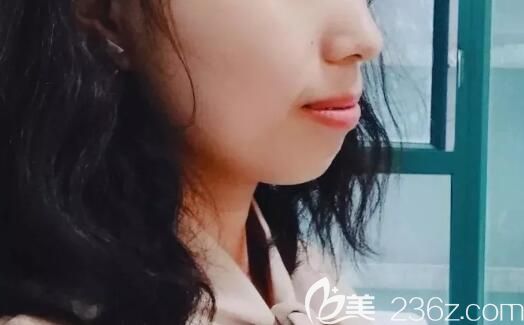 在威海舒好口腔做龅牙矫正中侧面样子