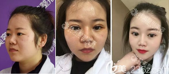 天水韩美石正平全切双眼皮+开眼角术前、第三天、20天对比照片