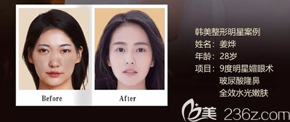 天水韩美整形董彭涛9度明星媚眼术+玻尿酸隆鼻+水光嫩肤图