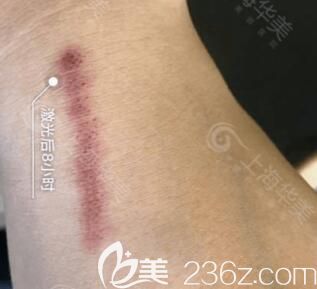上海华美医疗美容医院王珊青激光祛疤真人案例术后第1天