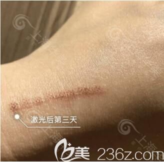 上海华美医疗美容医院王珊青激光祛疤真人案例术后第3天