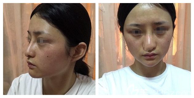 面诊南通维多利亚术前鹰钩鼻 面诊南通维多利亚术前鹰钩鼻