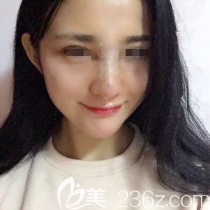 硅胶隆鼻矫正鹰钩鼻术后4天恢复 硅胶隆鼻矫正鹰钩鼻术后4天恢复