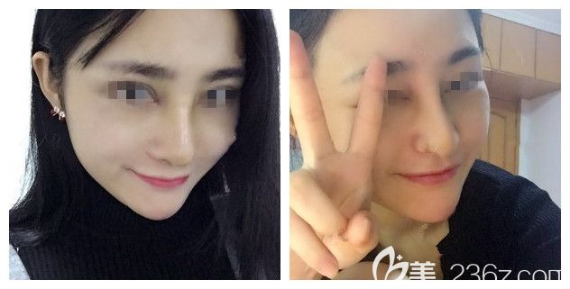 术后一周到南通维多利亚拆线鼻子恢复 术后一周到南通维多利亚拆线鼻子恢复