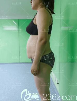 在北京上上相做腰腹吸脂前侧面样子