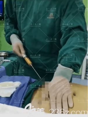 侯月华医生给我做腰腹吸脂当天手术照