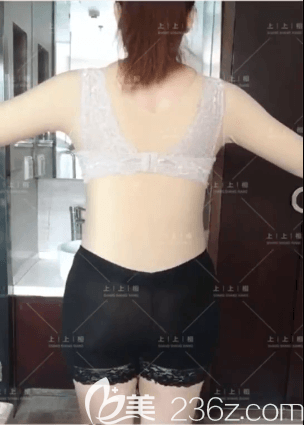 北京上上相医疗美容腰腹吸脂案例
