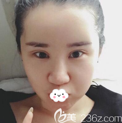 成都艾米丽脂肪填充术后4天恢复效果 成都艾米丽脂肪填充术后4天恢复效果