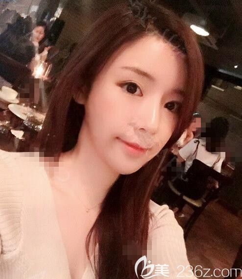 JJ洪镇柱整形梁海元透明颧骨缩小术眼鼻部手术脂肪移植后收获了娃娃脸