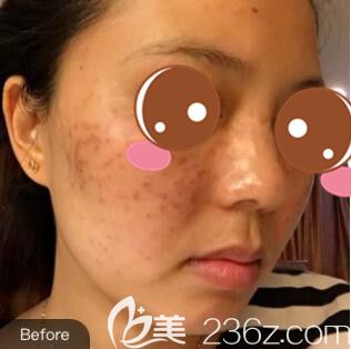了解到上海光博士做皮肤美容口碑好，我找彭春做了面部祛斑结痂后斑点就变淡很多