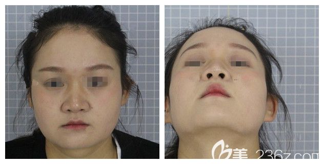 面诊常州美贝尔术前的我塌鼻子大圆脸 面诊常州美贝尔术前的我塌鼻子大圆脸