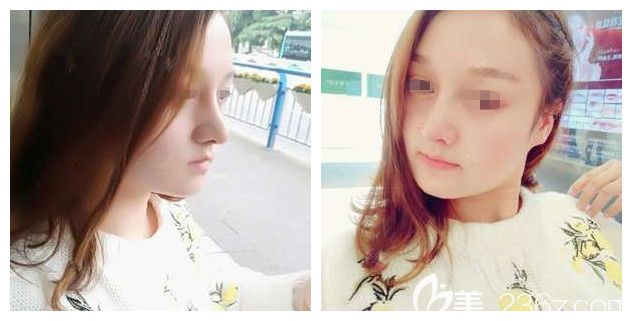 做完鼻综合+瘦脸术后一周<span style= 做完鼻综合+瘦脸术后一周<span style=