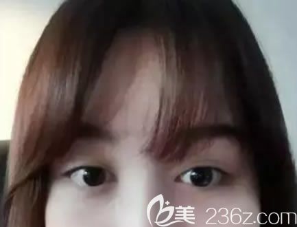 术前做失败的双眼皮照片 术前做失败的双眼皮照片
