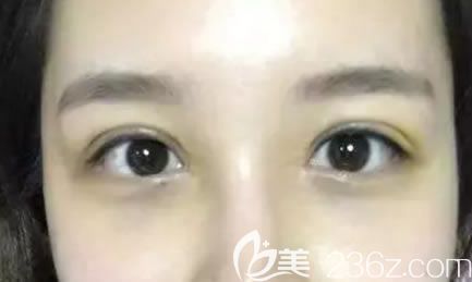 做双眼皮修复手术7天恢复图 做双眼皮修复手术7天恢复图