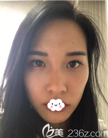 韩国BK整形医院鼻综合隆鼻+PRP自体脂肪面部填充真人案例 韩国BK整形医院鼻综合隆鼻+PRP自体脂肪面部填充真人案例