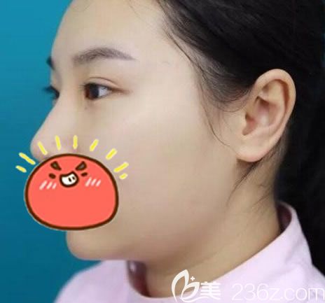 义乌阳光整容医院做双眼皮<span style=