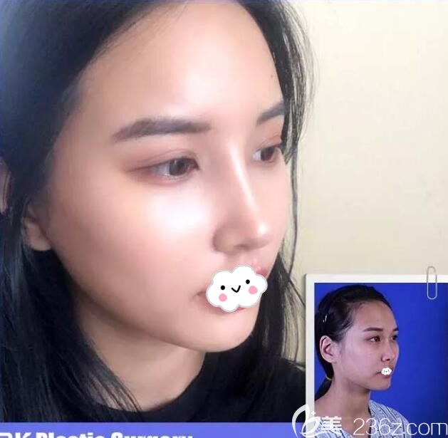 韩国BK整形医院假体隆鼻+脂肪填充全脸案例术后恢复图 韩国BK整形医院假体隆鼻+脂肪填充全脸案例术后恢复图