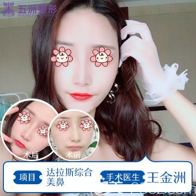 五洲莱美王金洲医生做达拉斯鼻综合术后效果 五洲莱美王金洲医生做达拉斯鼻综合术后效果