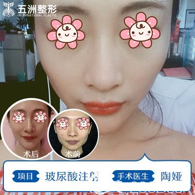 陶娅医生面部注射玻尿酸改善面部凹陷效果 陶娅医生面部注射玻尿酸改善面部凹陷效果