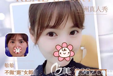 超皮秒祛斑术前术后对比 超皮秒祛斑术前术后对比