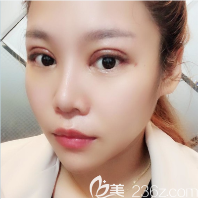 深圳米兰柏羽朱武根双眼皮修复案例术后7天 深圳米兰柏羽朱武根双眼皮修复案例术后7天