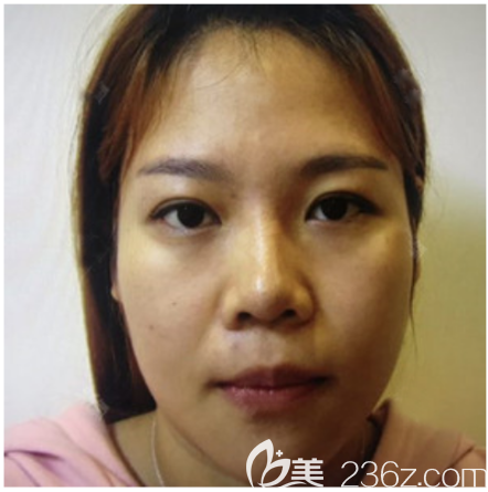 在深圳米兰柏羽做双眼皮修复术前照片 在深圳米兰柏羽做双眼皮修复术前照片