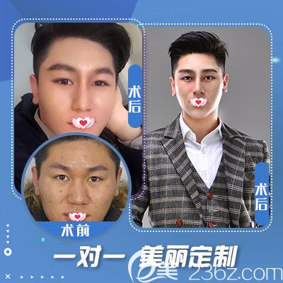 石家庄蓝山隆鼻手术案例 石家庄蓝山隆鼻手术案例