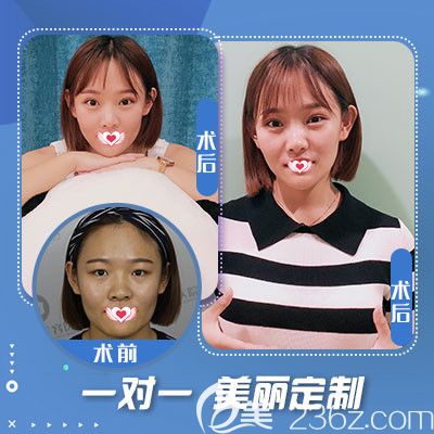 蓝山整形医院做双眼皮手术案例 蓝山整形医院做双眼皮手术案例