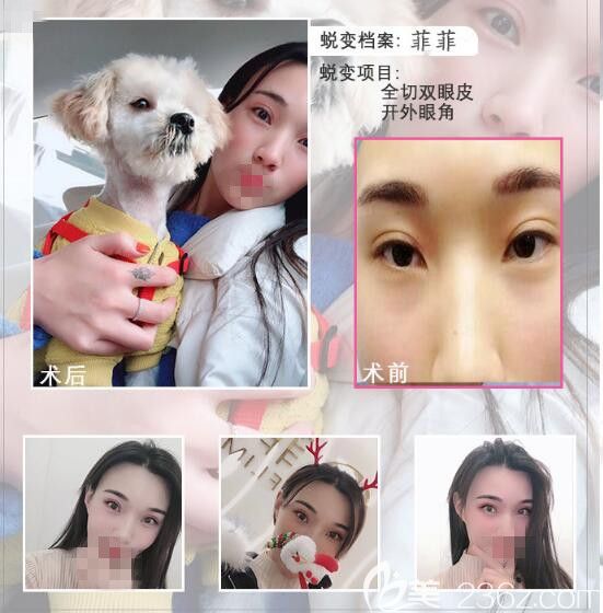 郑州菲林双眼皮手术前后对比照片