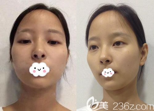 韩国麦恩李圣郁隆胸后又来做面部轮廓+额头缩小术+双眼皮真人案例 韩国麦恩李圣郁隆胸后又来做面部轮廓+额头缩小术+双眼皮真人案例