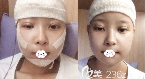 韩国麦恩面部轮廓+额头缩小术+双眼皮术后3天恢复图