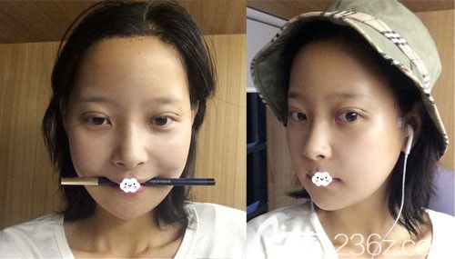 韩国麦恩颧骨颧弓下颌角+额头缩小术后10天恢复图