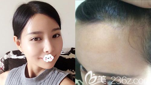 韩国麦恩额头缩小术后1个月恢复图与疤痕情况 韩国麦恩额头缩小术后1个月恢复图与疤痕情况