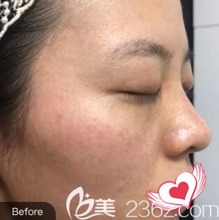 在雅美祛斑术前照 在雅美祛斑术前照