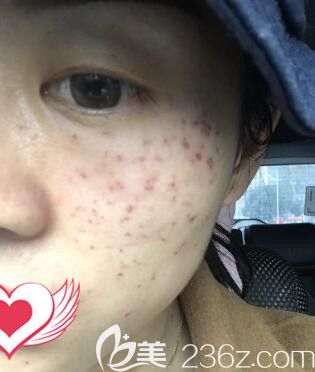 在雅美做皮秒祛斑术后照 在雅美做皮秒祛斑术后照