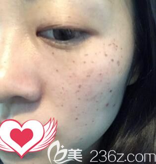 在雅美做皮秒祛斑术后5天效果 在雅美做皮秒祛斑术后5天效果