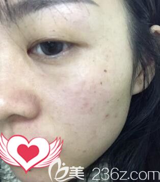 在长沙雅美做皮秒祛斑术后16天效果 在长沙雅美做皮秒祛斑术后16天效果