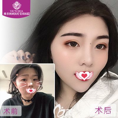 张家口维多利亚做双眼皮案例